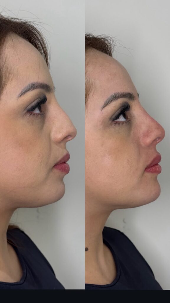 Comparação de perfil facial, antes e depois de procedimento estético